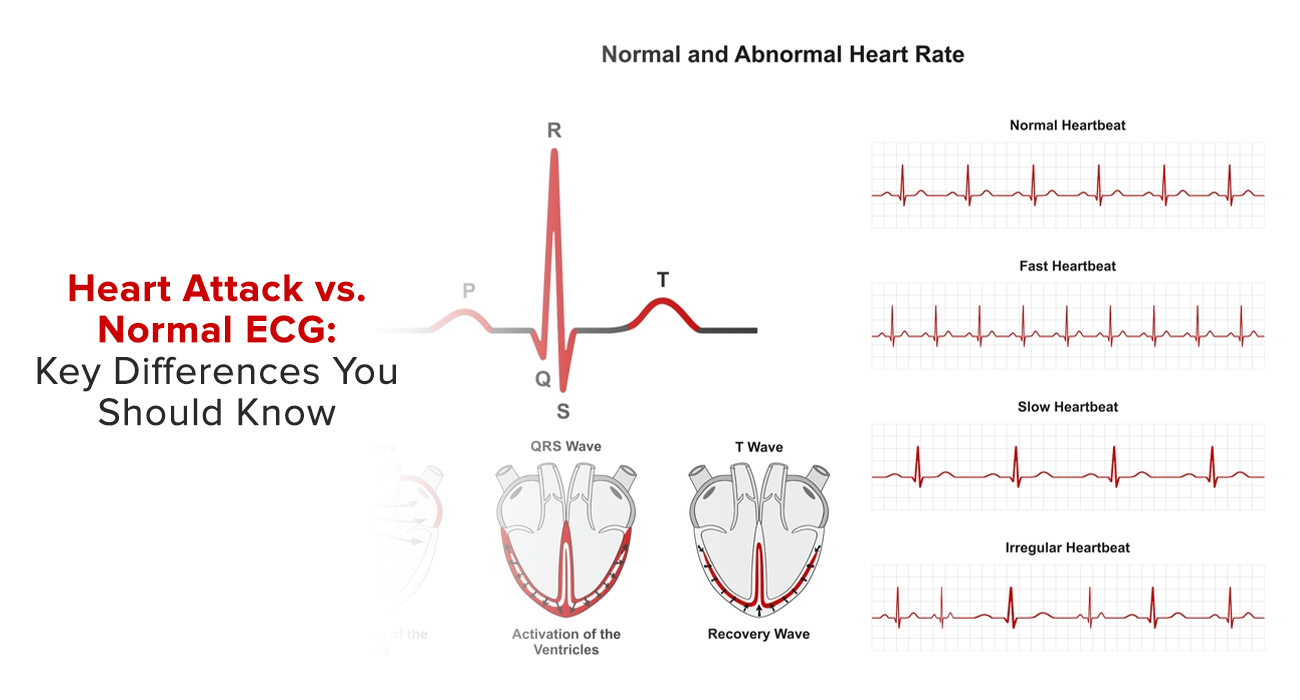 Heart Attack vs. Normal ECG: Key Differences You Should Know